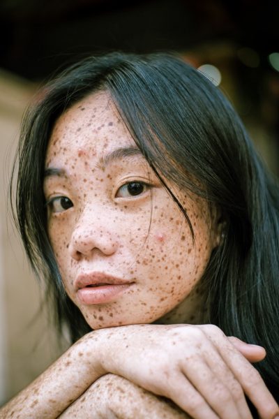 Eine Frau mit Sommersprossen hat vereinzelte Pickel im Gesicht